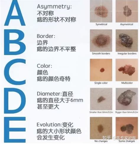 痣 顏色|痣有4種顏色，出現在「手腳這邊」的痣可能是皮膚癌！「ABCDE。